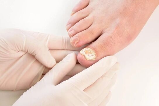 Doctors recommend Fungent to treat athlete's foot