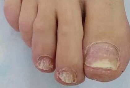 The nails were badly affected by the fungus