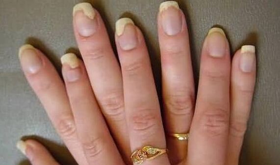 Here's what the nail fungus looks like in the exacerbation stage