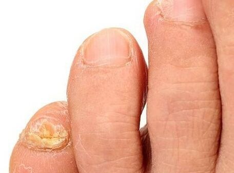 Leg fungus