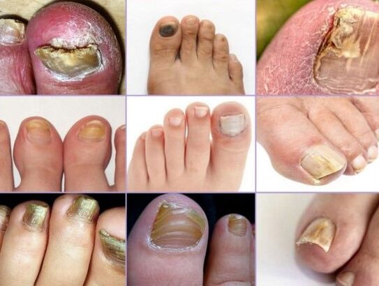 Nail damage to different types of fungi