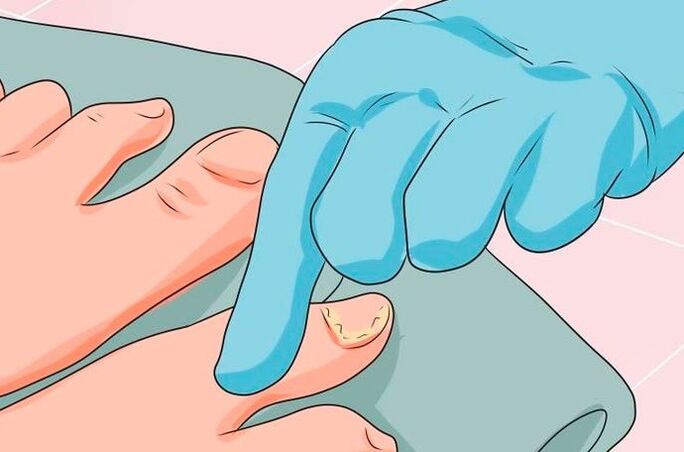 The first signs of mycosis of the nails