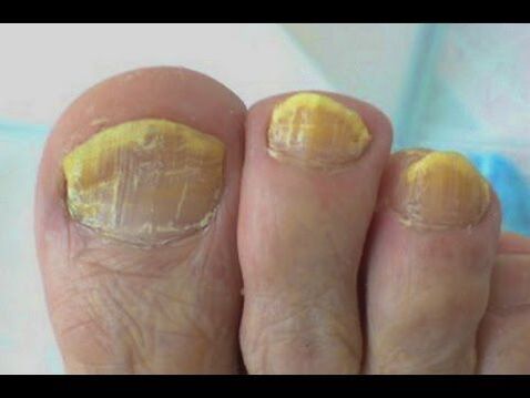 Fungi treatment