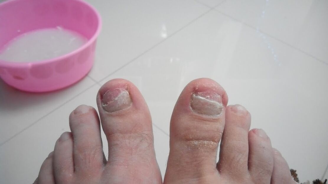 The fungus of the feet