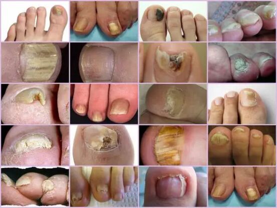 Onychomycosis of different nail localization