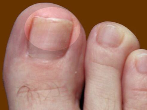 The lesion of the sponge